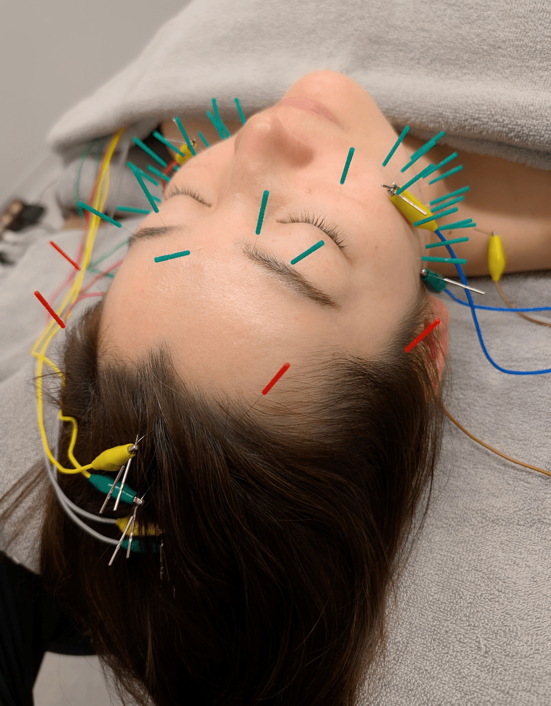 美容鍼の施術風景(顔・頭部への鍼灸)